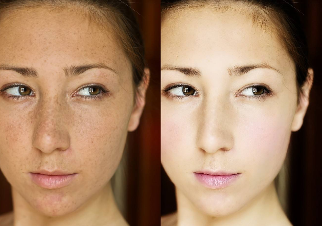 磨皮手術效果圖 (54) 