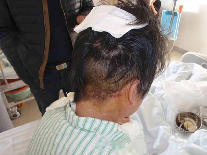 原發性三叉神經痛症狀