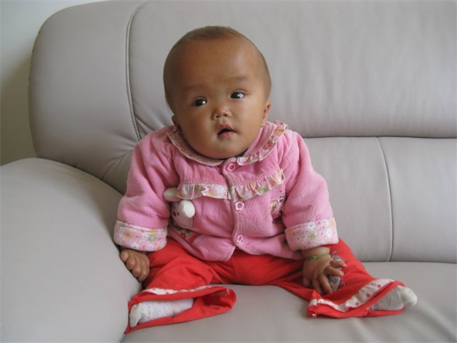 幼兒腦積水高清