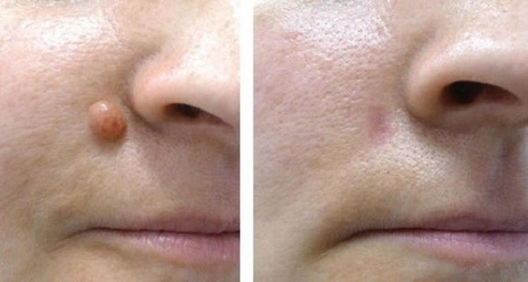 皮膚纖維瘤 (32) 