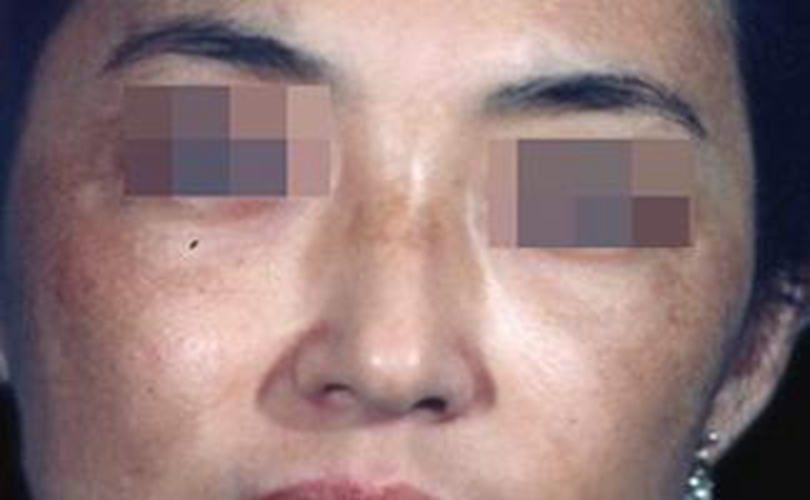 臉蛋患皮膚黑變病