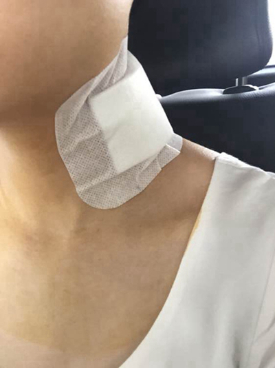 頜下淋巴結腫大