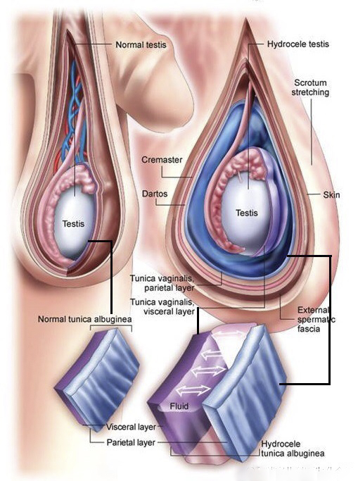 小兒鞘膜積液 (35) 