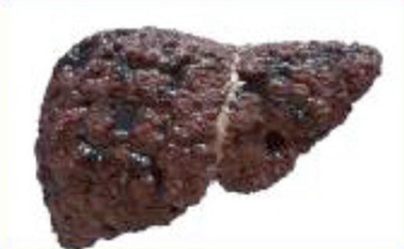  重度的酒精肝併發症的