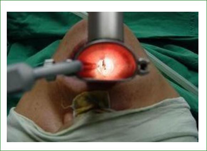 治療聲帶息肉手術