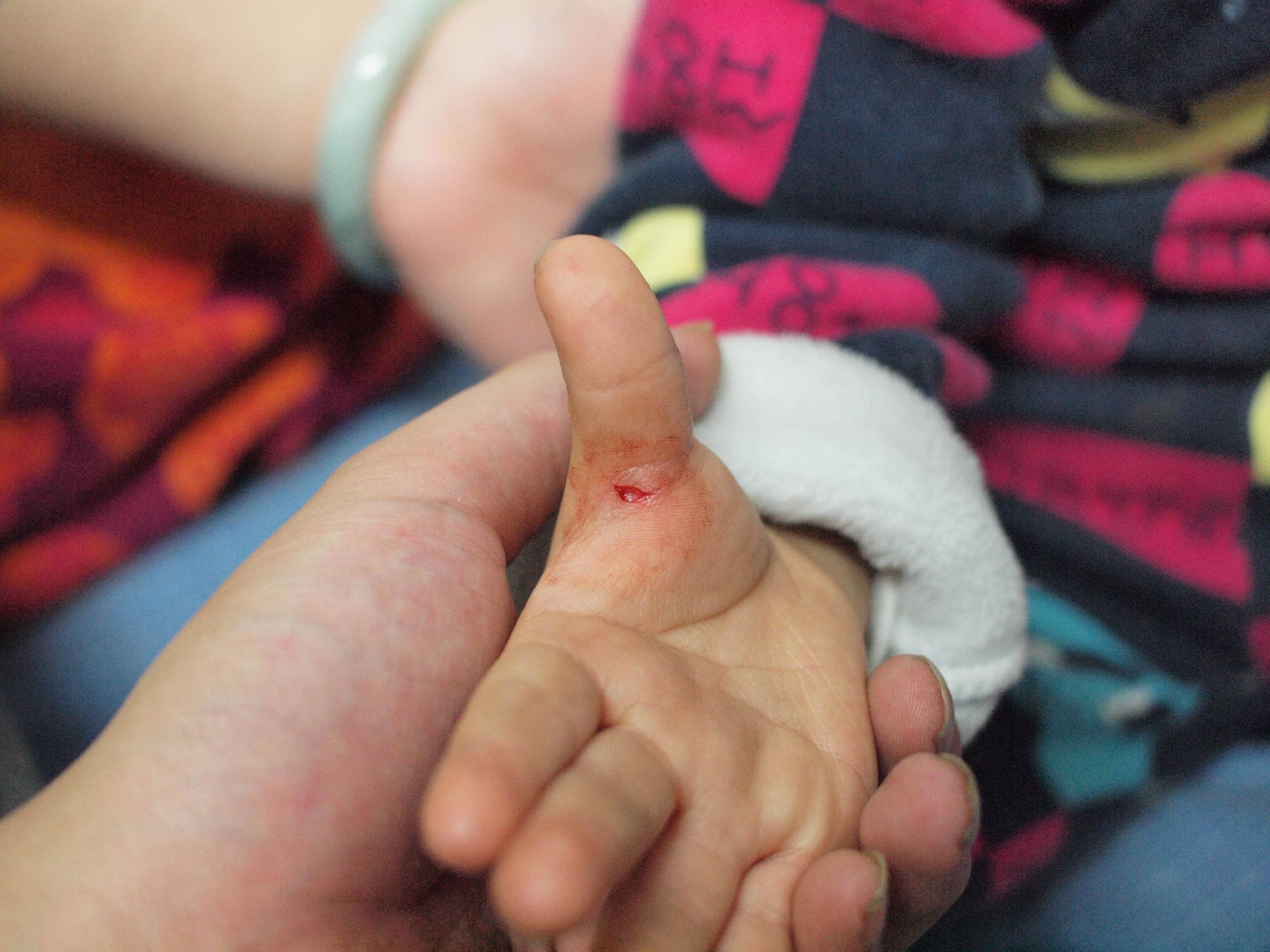 嬰兒破傷風傷口