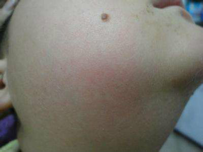 慢性淋巴結炎 (44) 