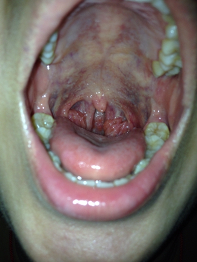 食道炎的症狀圖 (51) 