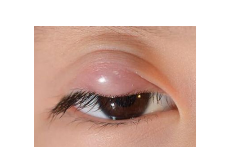 眼睛麥粒腫初期