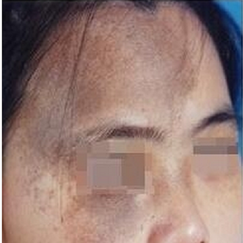 獲得性太田痣樣斑