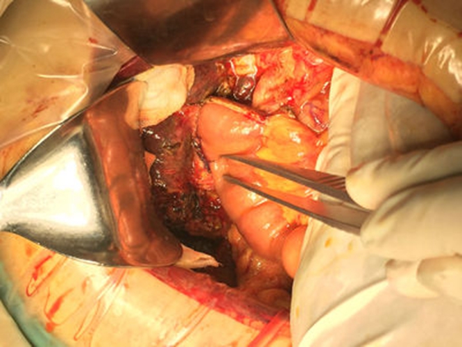 肝外膽管癌黃疸表現