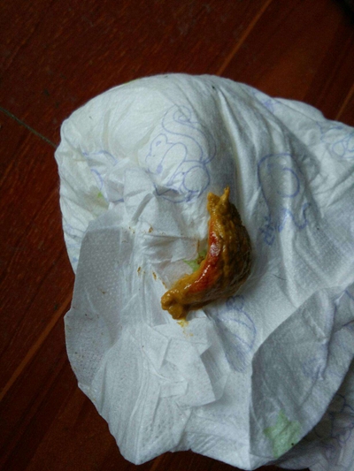 腸癌的症狀 (49) 