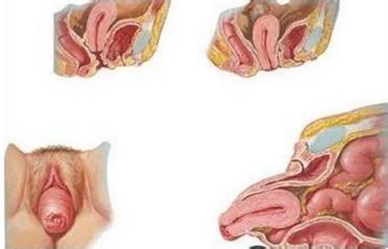 子宮脫垂早期症狀有哪些