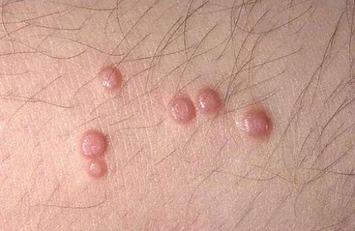 中藥治療傳染性軟疣 