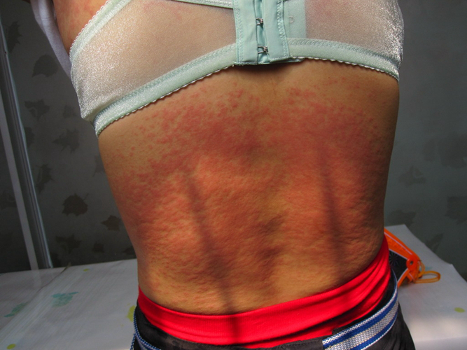 腰部接觸性皮炎