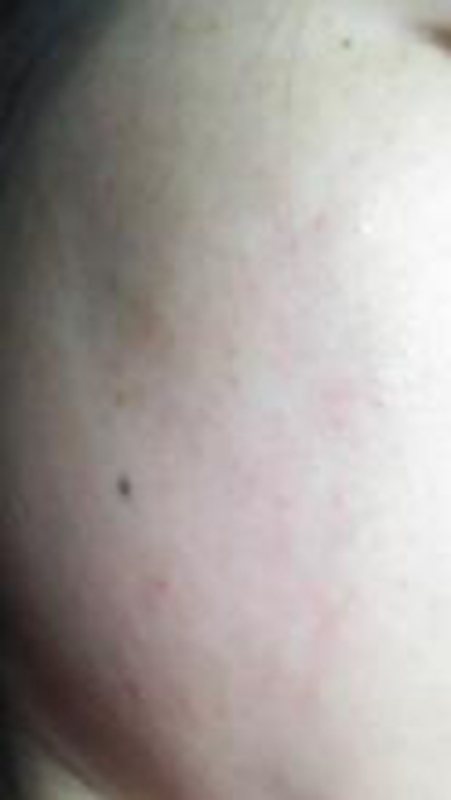 面部日光性皮炎