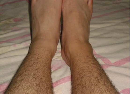 腳骨頭突出 (45) 