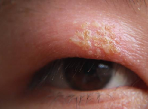 眼睛麥粒腫初期