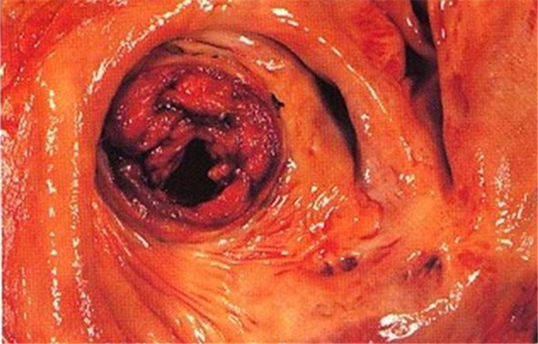 腦供血不足血管血栓