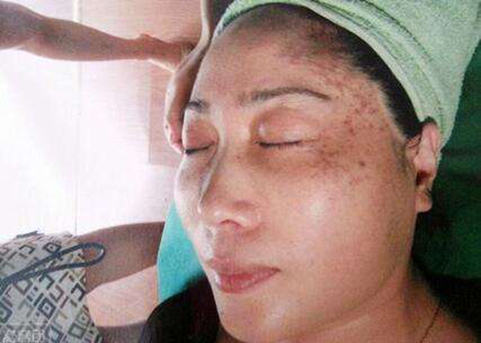 如何預防老年斑