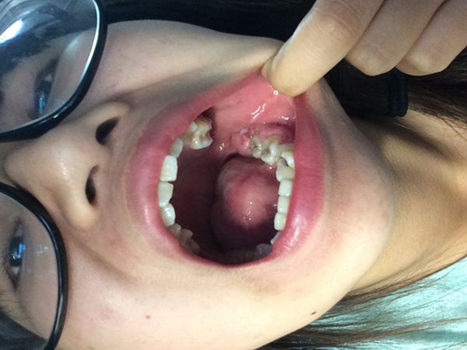 嘴巴里淋巴結髮炎