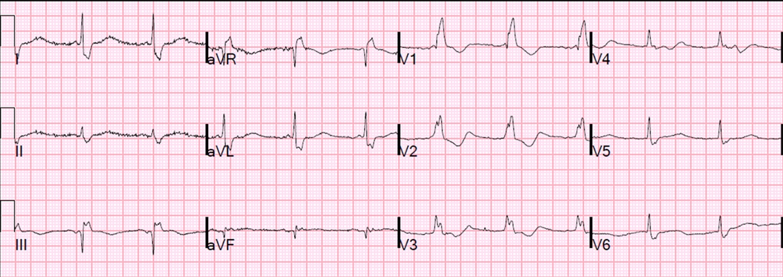 預激綜合徵心電圖 (88) 