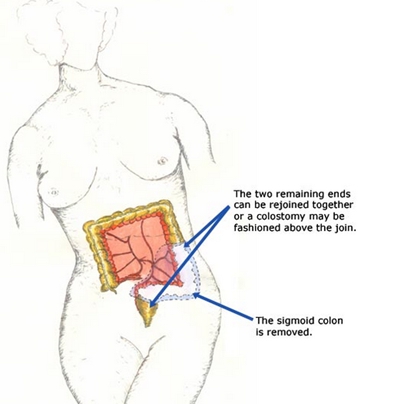 盲腸的位置 (33) 