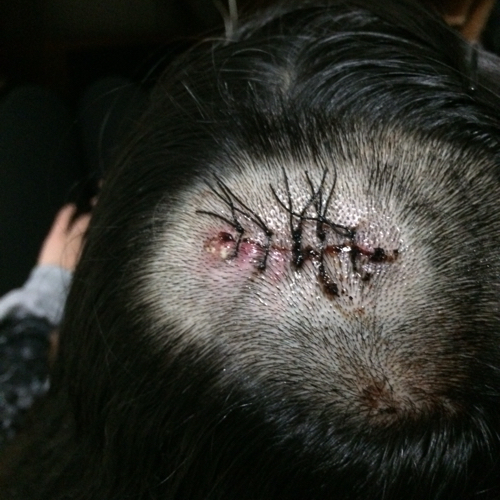 皮脂腺痣術後第四天