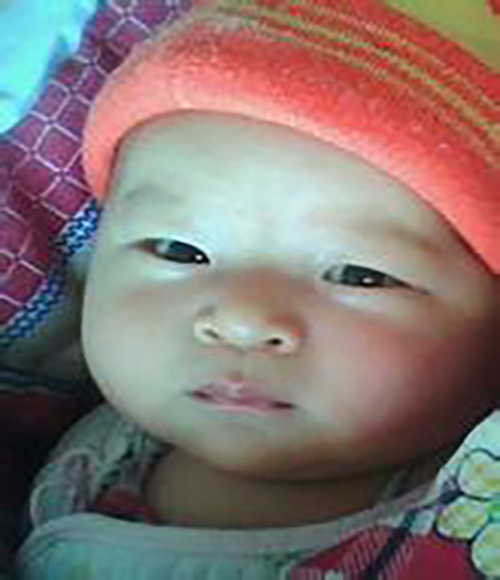 小兒甲狀腺腫大