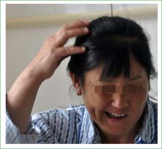 三叉神經痛症狀有哪些