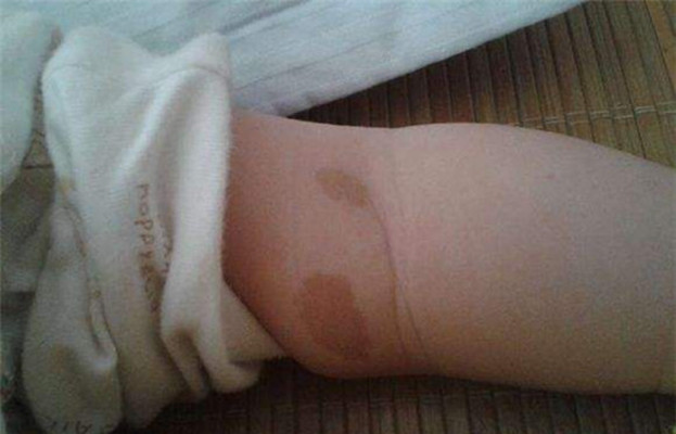 牛奶咖啡斑 (46) 