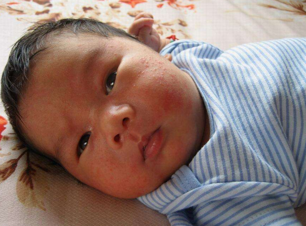 臉上皮膚過敏症狀