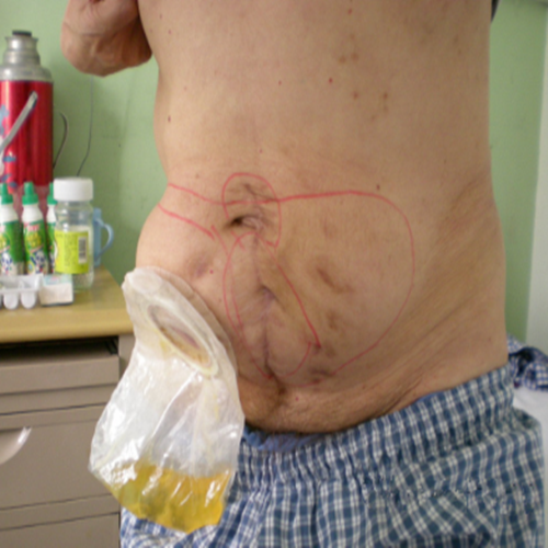 老年人白線疝術後