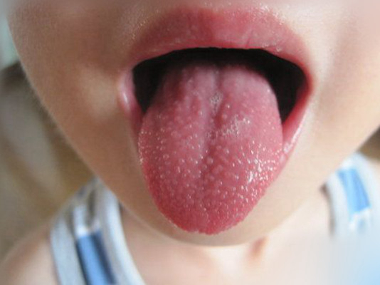 小兒猩紅熱症狀