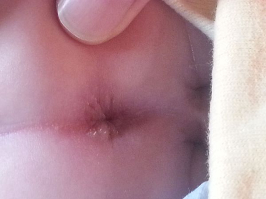 嬰兒肛周膿腫 (42) 