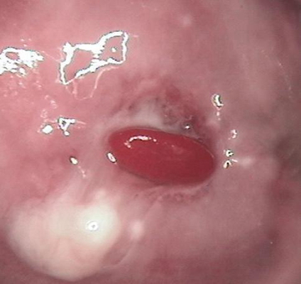 淋病的症狀 (41) 