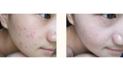 磨皮手術效果圖 (36) 