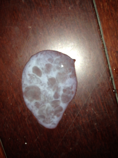 不正常精液液化