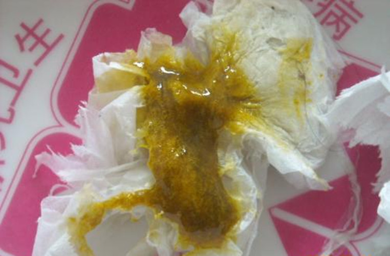 四個月嬰兒母乳性腹瀉大便