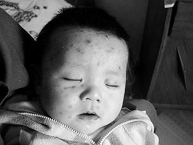 天花與水痘區別