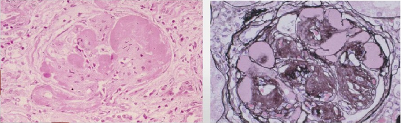 糖尿病腎病早期基底膜