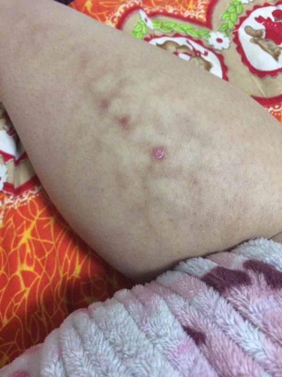 早期靜脈炎腿部