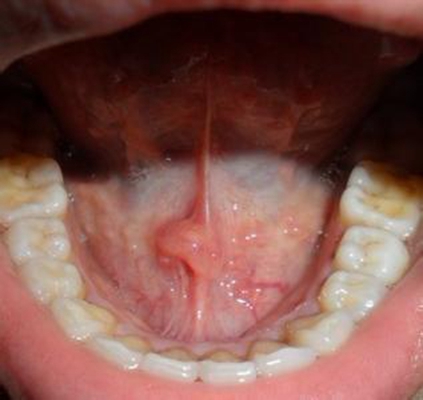 口腔癌的前兆 (54) 