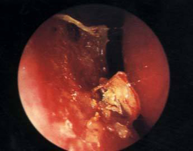 輕微細菌性鼻腔慢性鼻炎