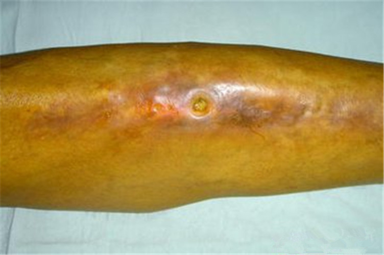 慢性硬化性骨髓炎