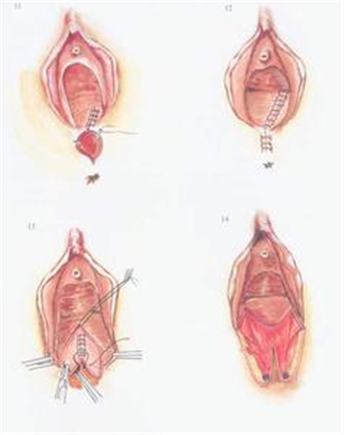 會陰撕裂修復術組圖