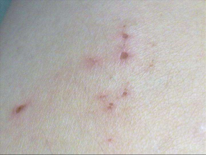 被跳蚤咬的症狀