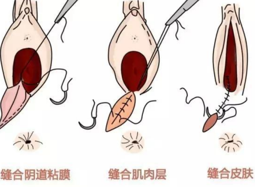 正常的人工陰道