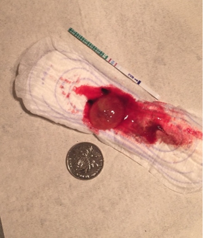 流產掉下來的孕囊