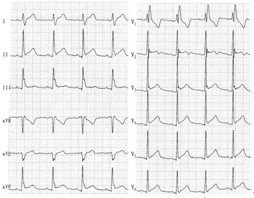 高鉀血癥心電圖 (58) 
